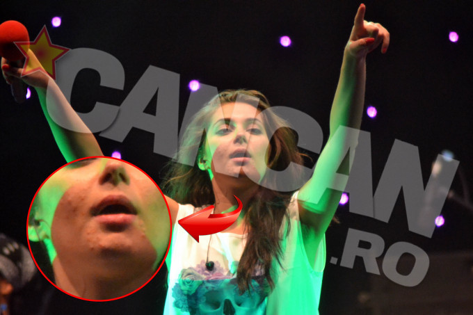 Elena s-a luptat ceva vreme cu acneea.