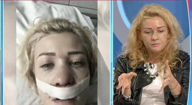 Medicii i-au reconstruit nasul bucată cu bucată