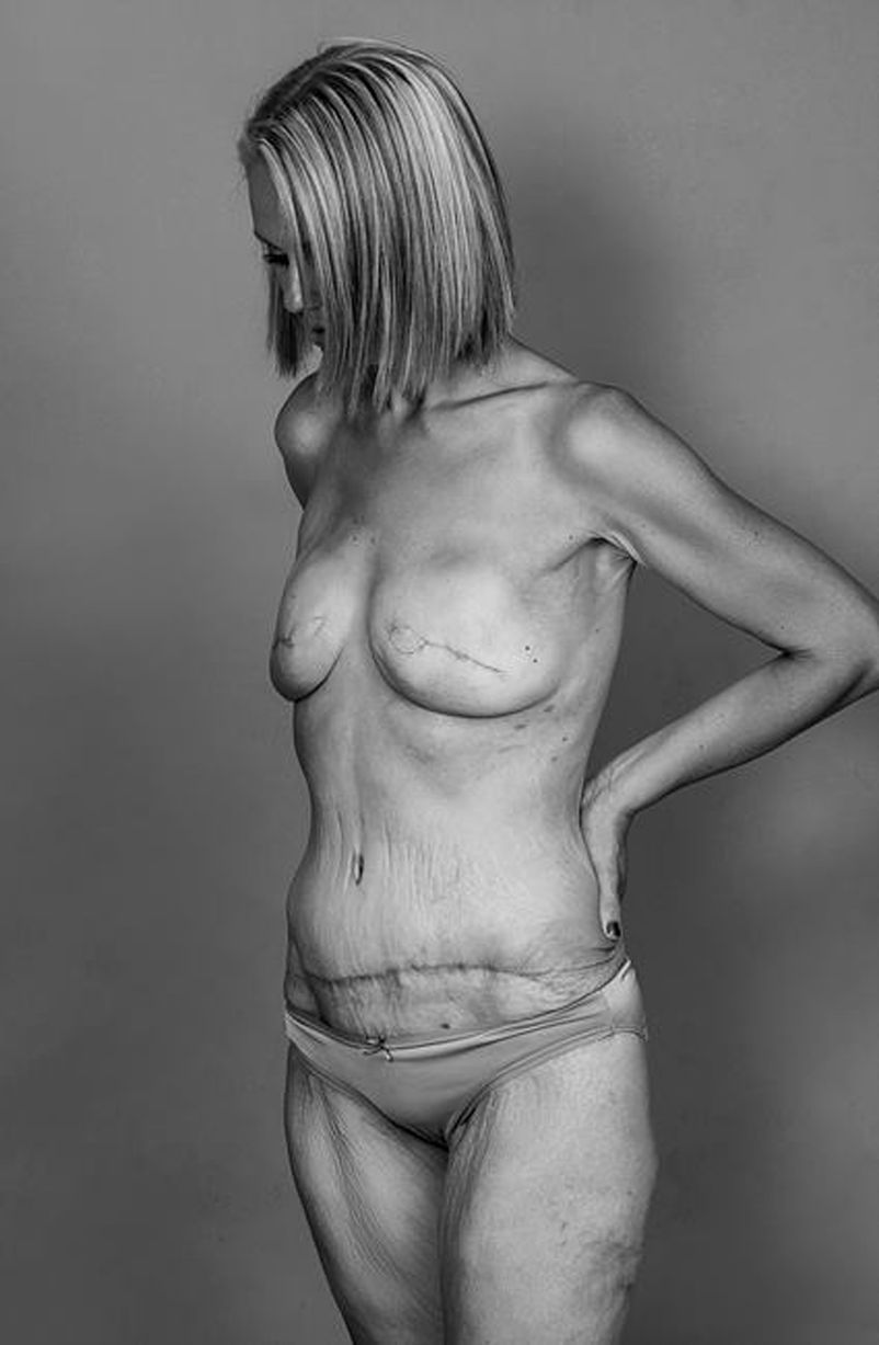 Cicatricile operatiilor i-au ingrozit pe prietenii de pe Facebook