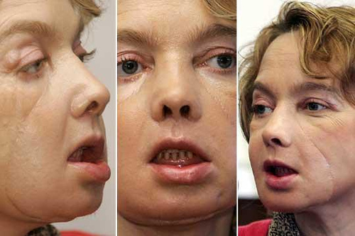 Medicii francezi au reuşit imposibilul, dar nu au reuşit să o mai ţină în viaţă