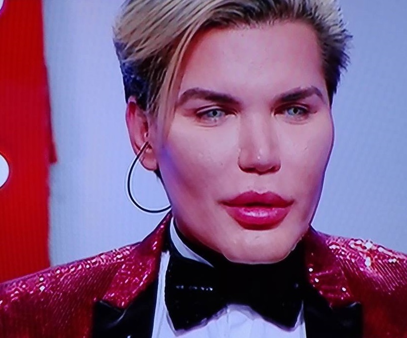 Rodrigo Alves, după ce a reuşit să-şi salveze nasul cangrenat