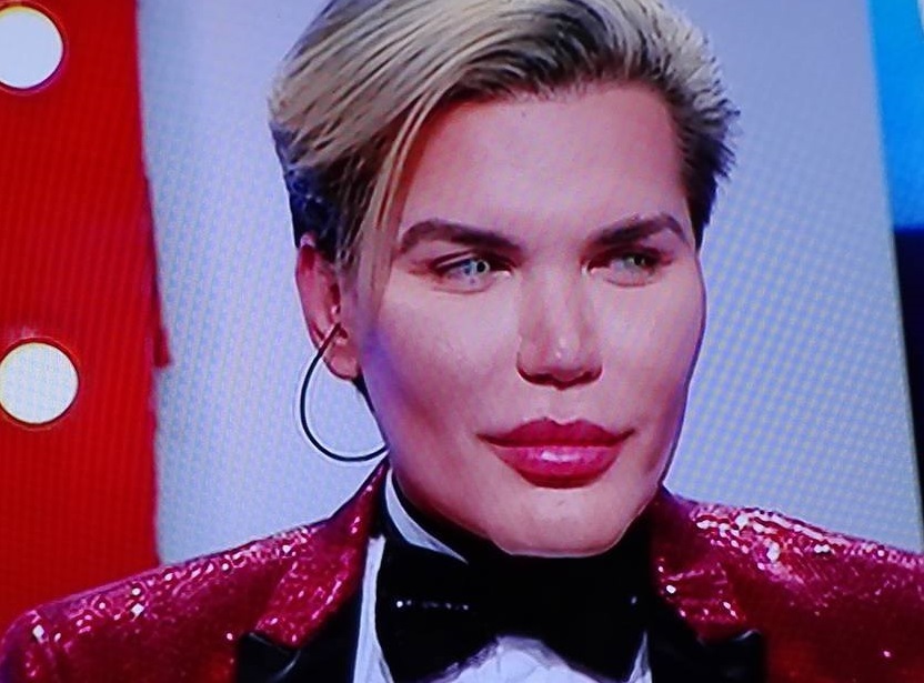 Rodrigo Alves, după ce a reuşit să-şi salveze nasul cangrenat