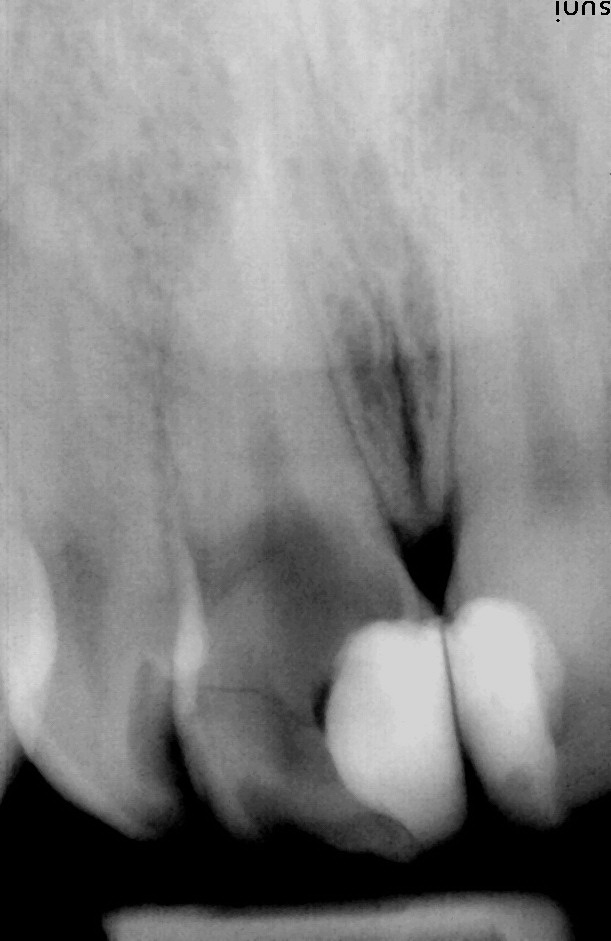 Radiografia dintelui