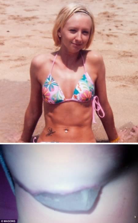 Siliconul i-a iesit prin san