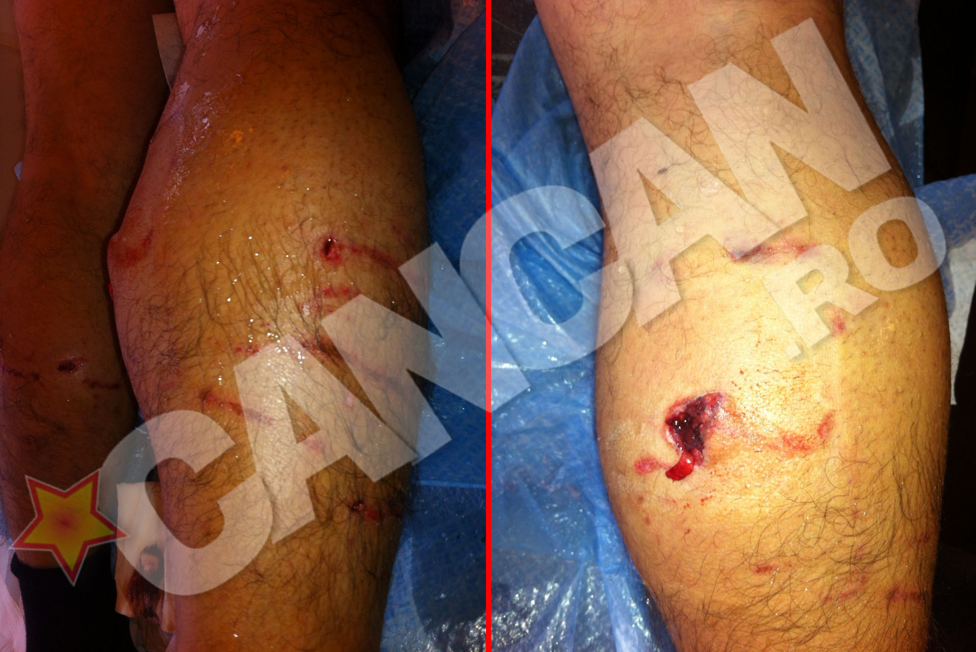 Cainii l-au atacat la nivelul picioarelor