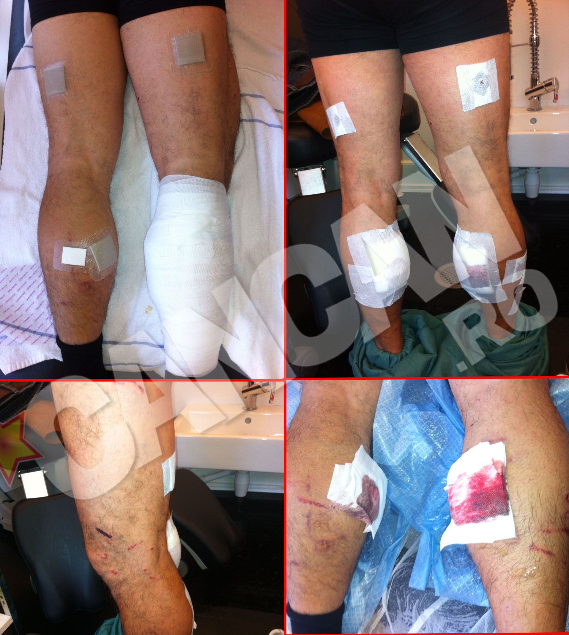 Cainii l-au atacat la nivelul picioarelor