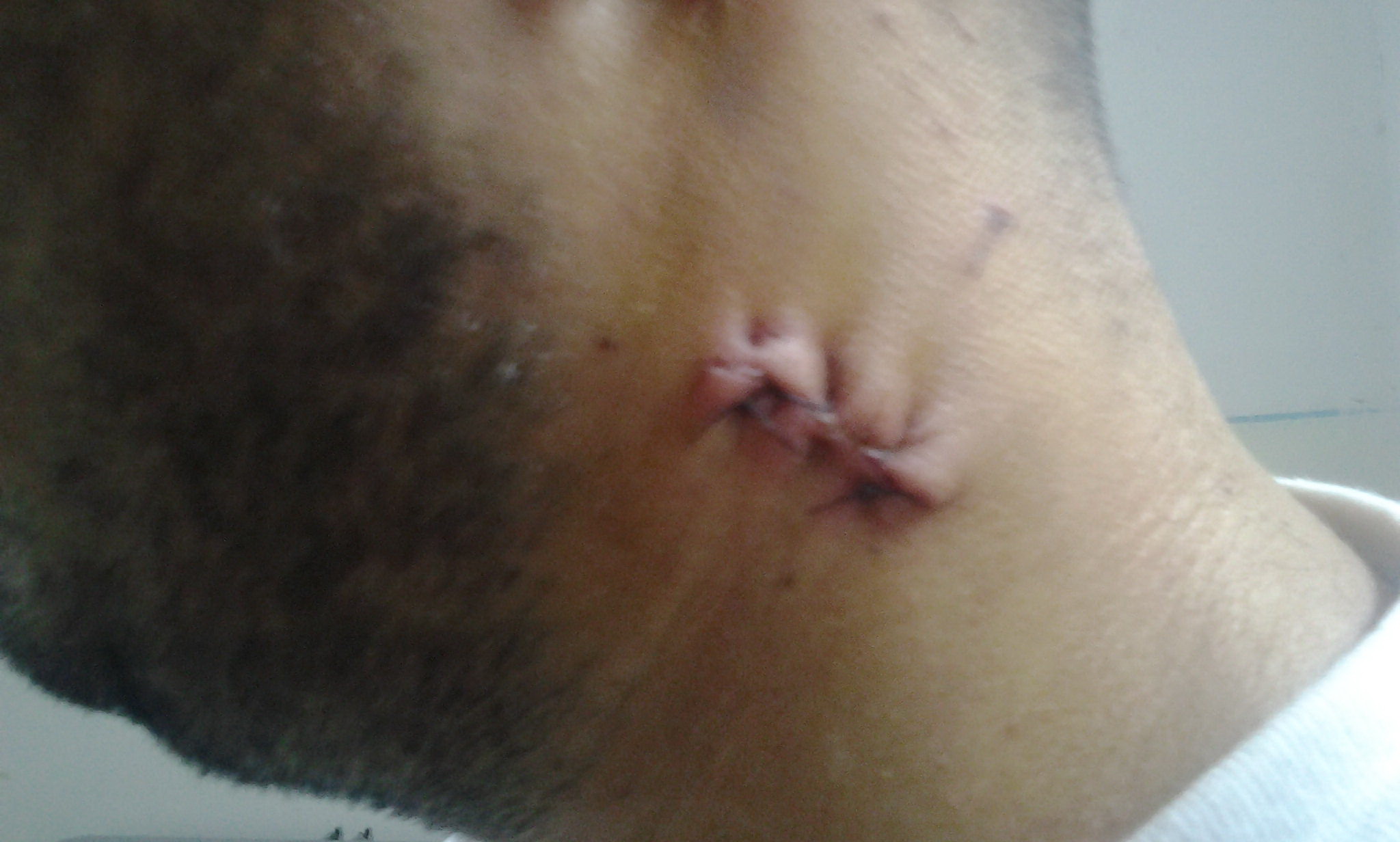 Cornel a fost injunghiat in gat de catre un recidivist