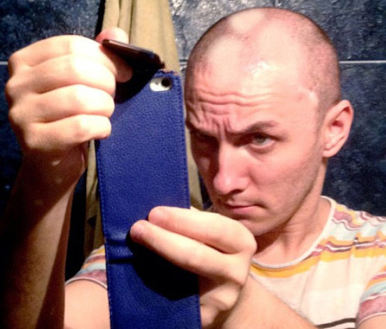 Asa arata Mihai Traistariu la scurt timp dupa implantul de par pe care l-a facut la o clinica din Turcia