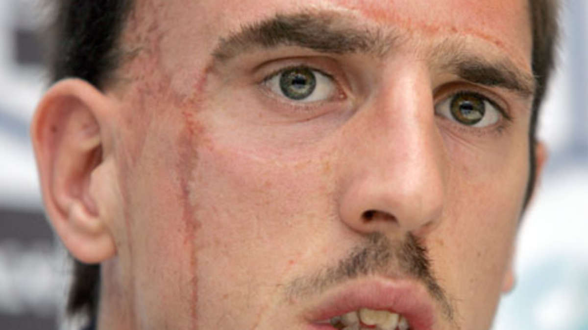 Frank Ribery a povestit ca mult timp copiii au ras de felul in care arata