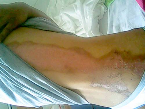 Asa arata la cateva zile de la accident, rana Elizei