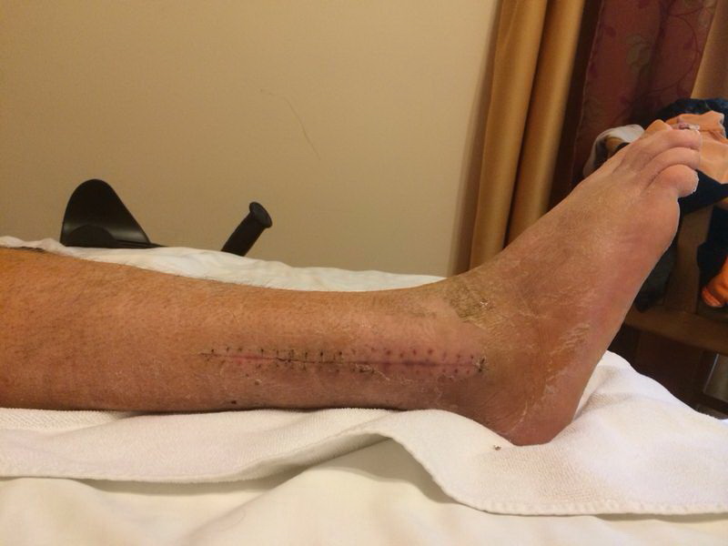 Asa arata piciorul drept al lui Dan Roman, cel la care fotbalistul a fost operat in decembrie 2013