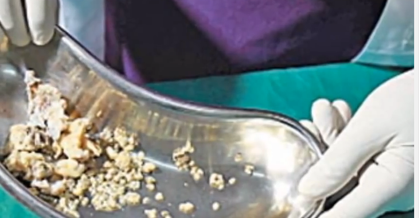 Dentistii i-au scos tanarului peste 200 de dinti (foto:youtube)