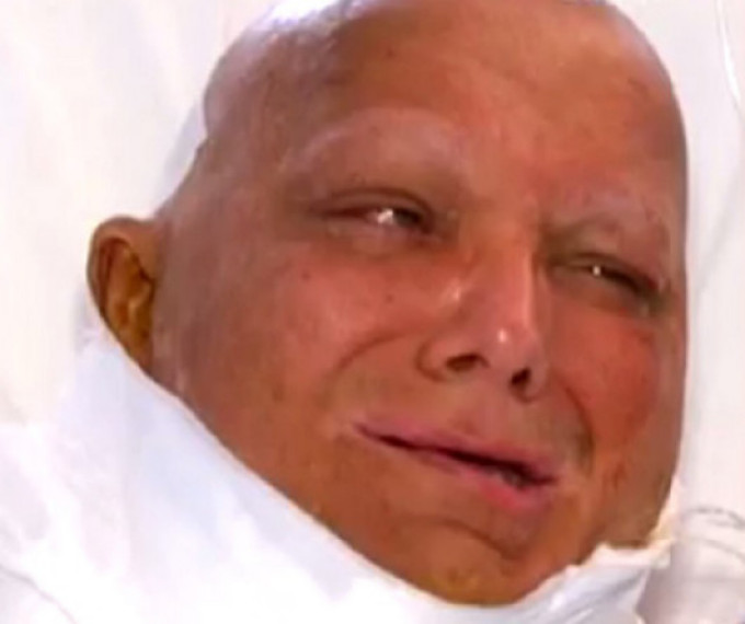 Asa arata stilistul imediat dupa operatie