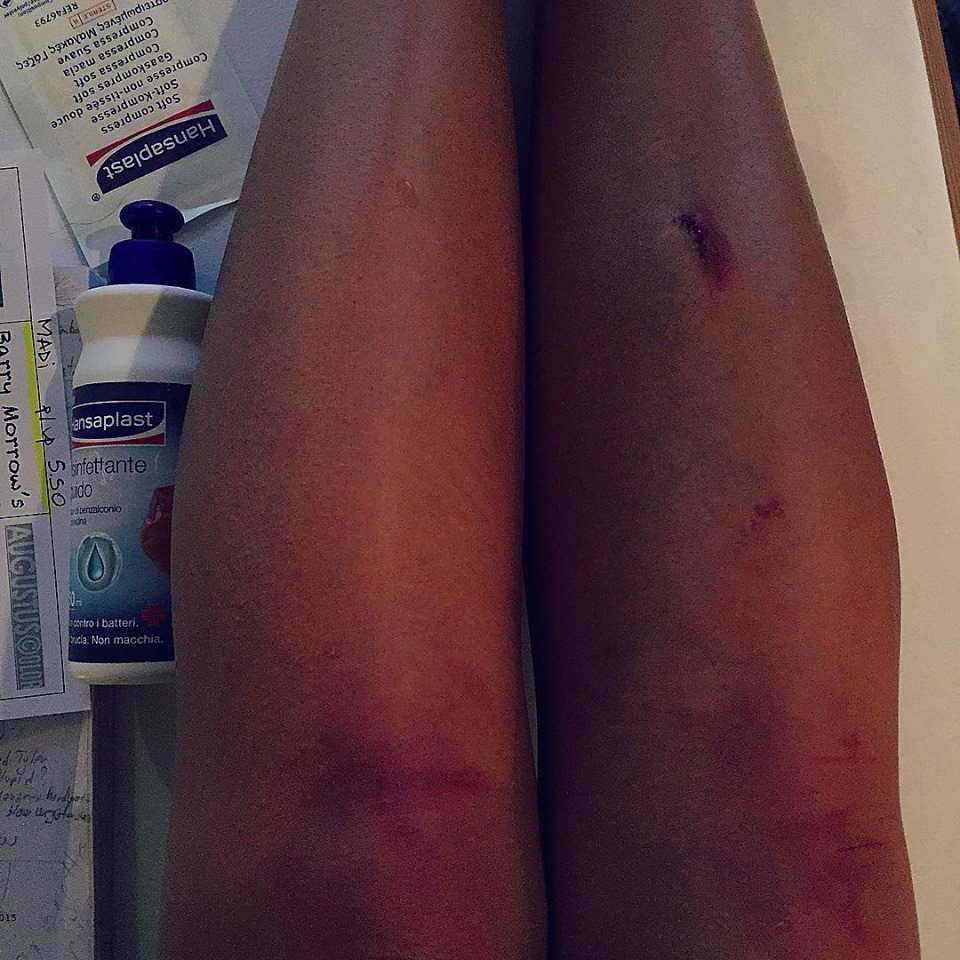 Madalina Ghenea s-a lovit la picior.