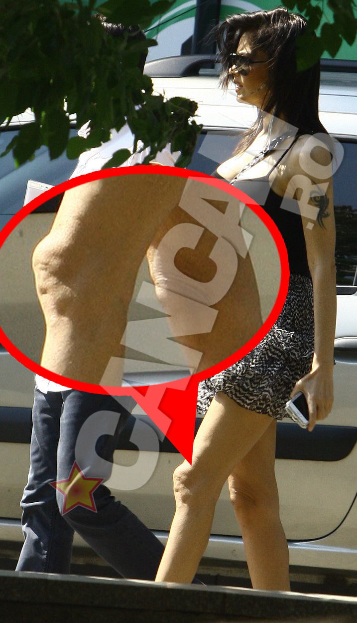 Pielea atarna inestetic, iar oasele sunt proeminente