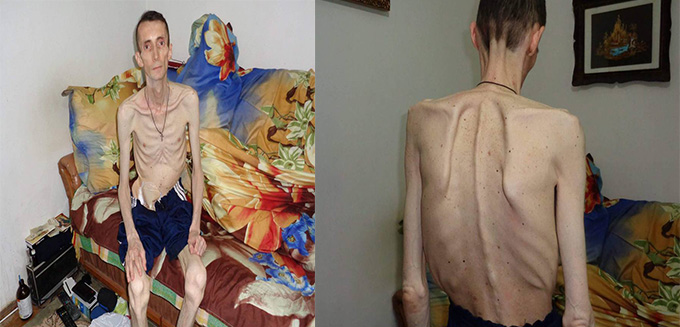 Asa arata corpul unui barbat din Iasi, de 47 de ani