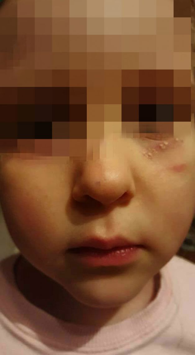 Educatoarea ar fi incercat să-şi acopere urmele cu fond de ten, susţine mama copilului, în timp ce cadrul didactic spune că a dat-o pe fetiţă cu o cremă.