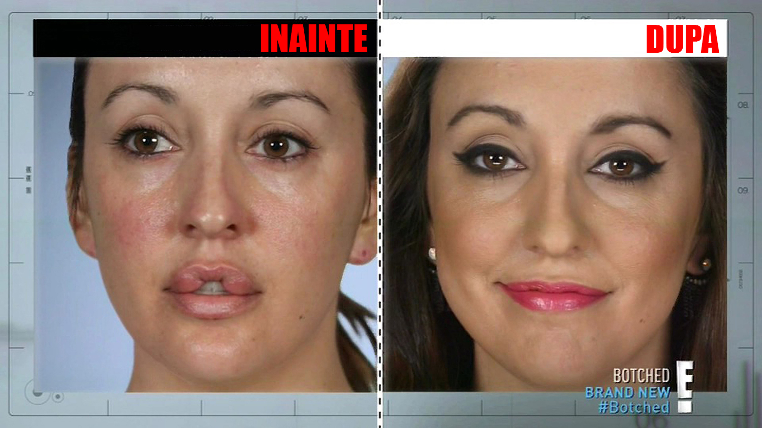 Aşa a arătat tânăra de 30 de ani, timp de un deceniu, până să apeleze din nou la chirurgie estetică