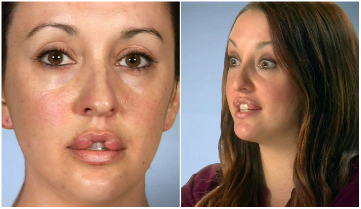 Keara nu a mai putut să mănânce sau să îşi închidă gura aşa cum trebuie timp de 10 ani