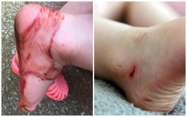 O fetiţă s-a rănit la picioruş, după ce a purtat o pereche de sandale noi.