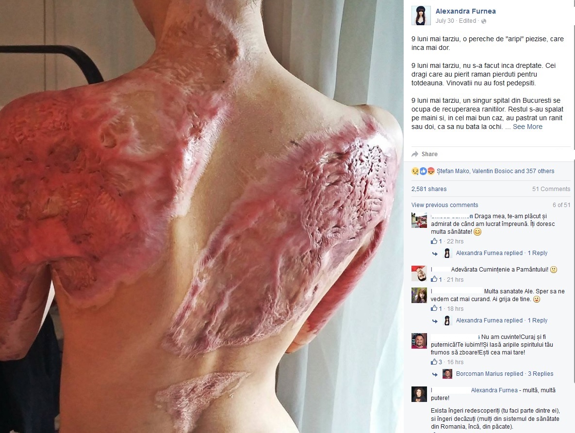 Aşa arată acum tânăra, după nouă luni de la tragedia din Clubul Colectiv