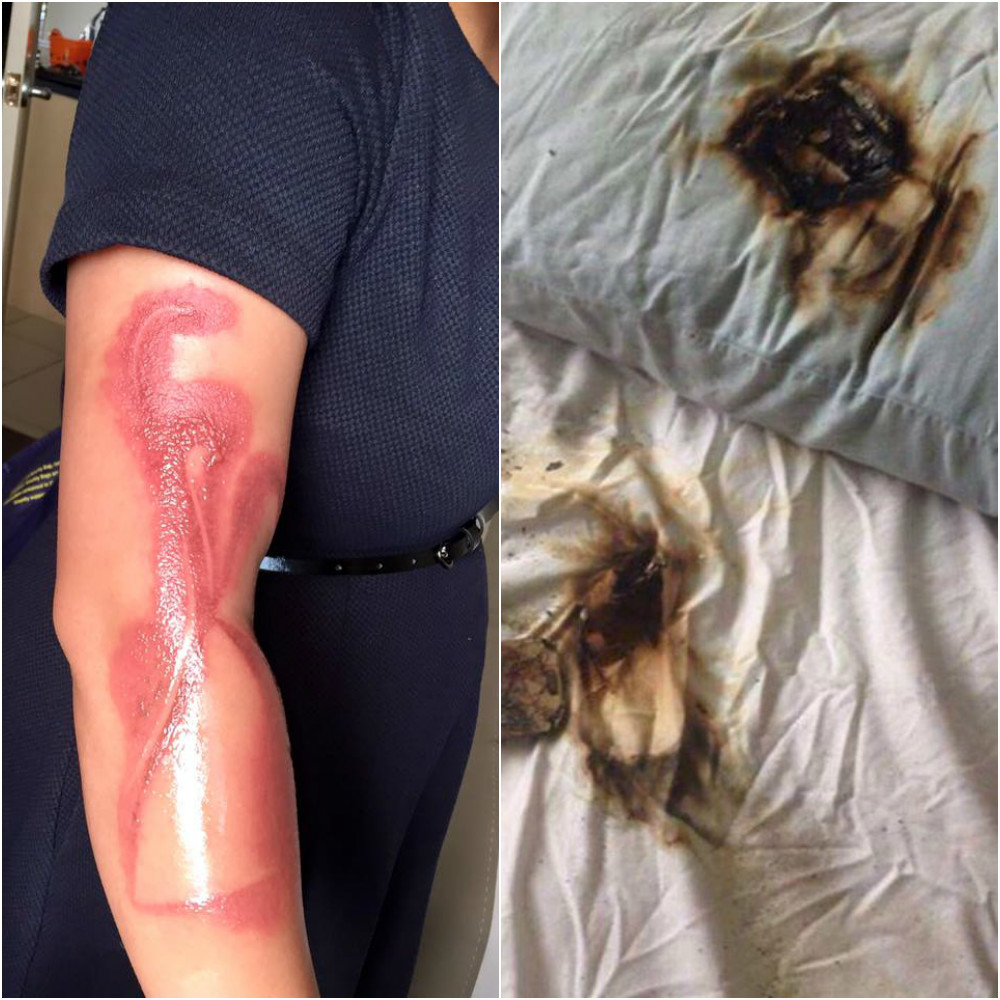 Tânăra a suferit o arsură gravă la nivelul braţului din cauza unui iPhone 7