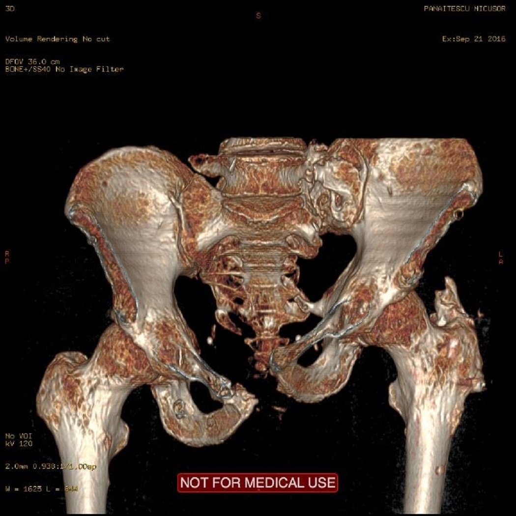 Aşa arătau bazinul şi femurul lui Nicu Panaitescu când a fost externat de la Floreasca