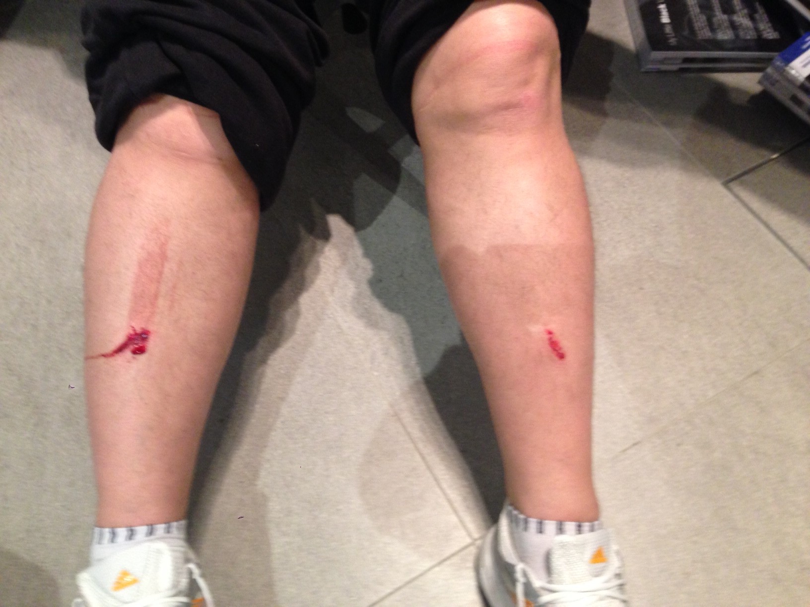 Ranile provocate de cazatura au fost foarte serioase