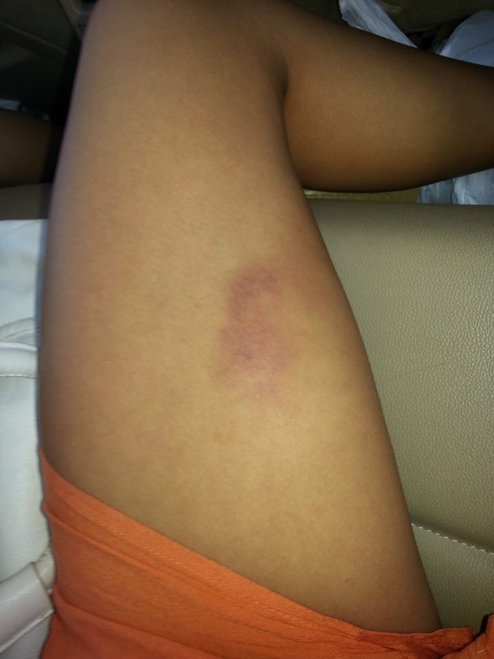 Dansul la bara poate fi un sport periculos