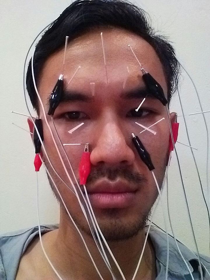 Nini a facut trei saptamani acupunctura