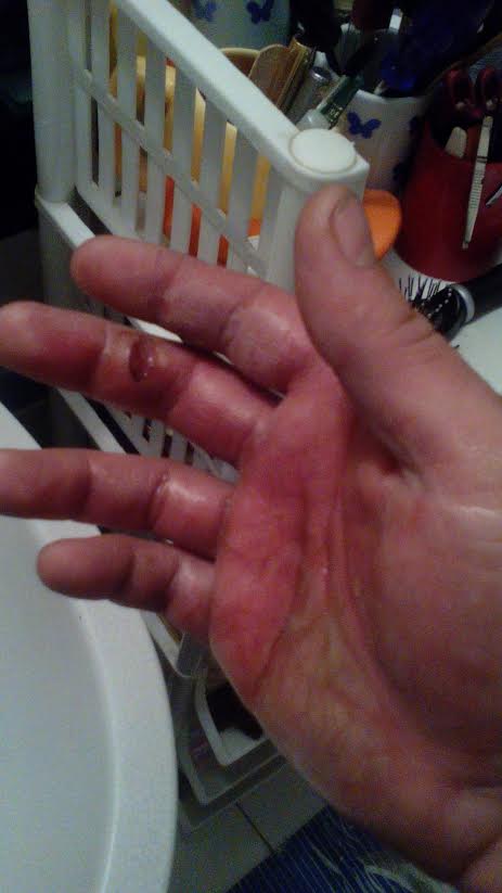 A ajuns direct la spital dupa ce o racheta pirotehnica i-a explodat in mana