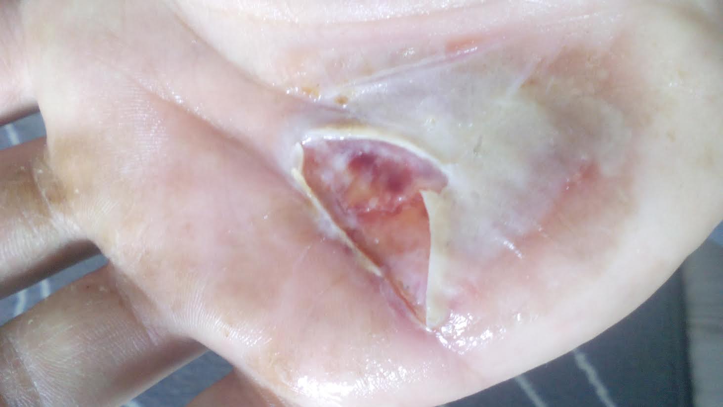 Imediat dupa nefericitul accident, bucuresteanul si-a dat cu albus de ou pe mana, lucru care i-a atenuat durerile