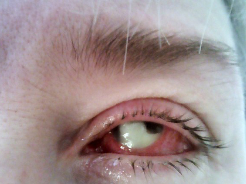 FOTOGRAFII ŞOCANTE! O mamă a doi copii şi-a pierdut un ochi din cauza lentilelor de contact!