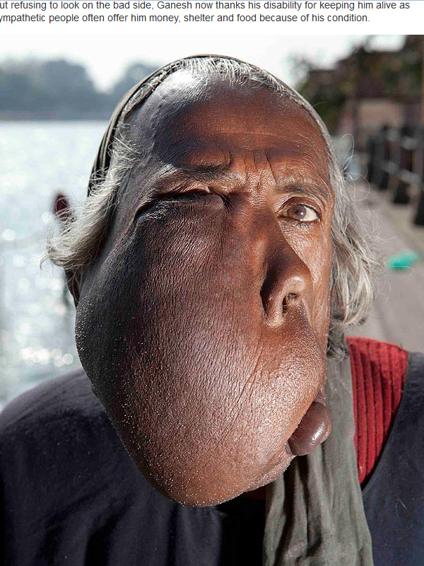 Imagini şocante! Un bărbat transfigurat de o boală rară este recunoscător pentru asta -