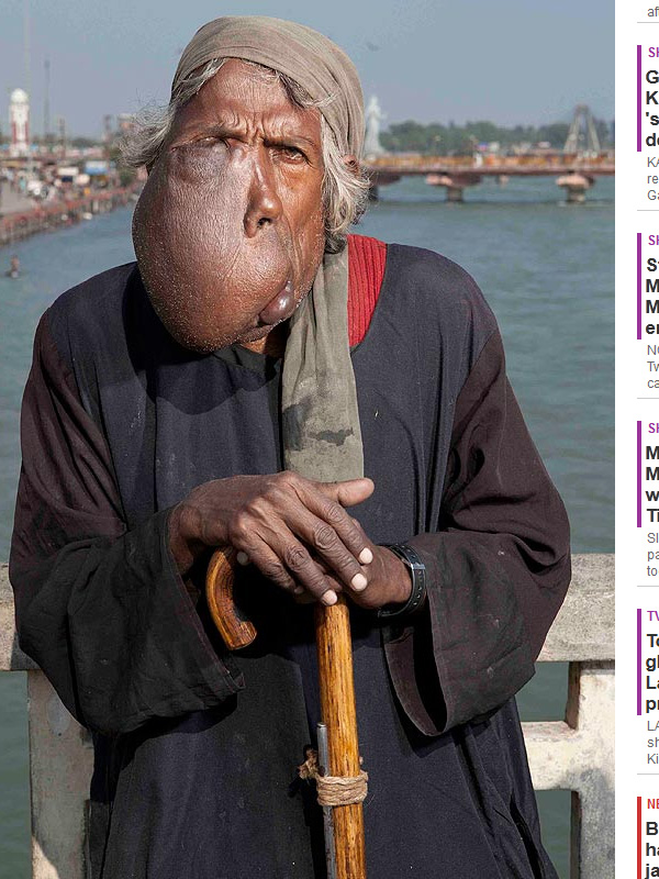 Imagini şocante! Un bărbat transfigurat de o boală rară este recunoscător pentru asta -