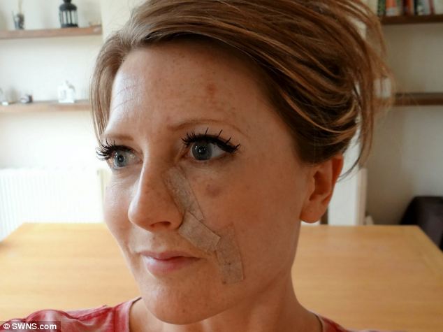 Asa arata dupa operatie