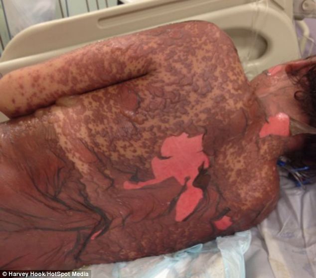 A avut o reactie alergica care i-a facut pielea sa se desprinsa de pe corp