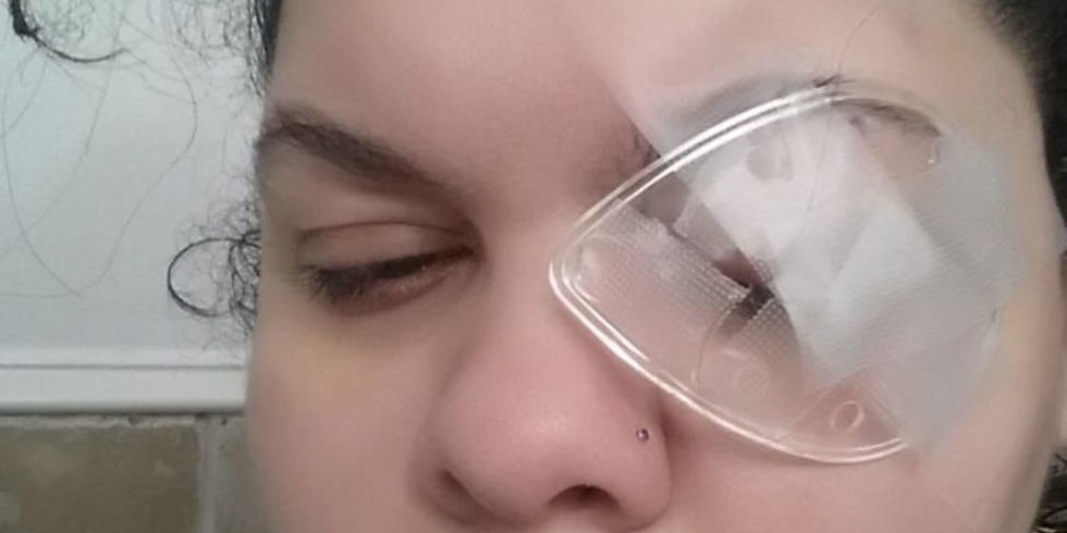 Tânăra şi-a pierdut ochiul stâng din cauza unui firicel de sclipici