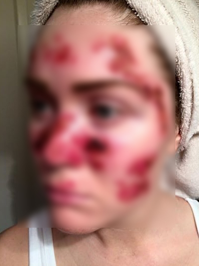 Tânăra a dezvoltat cea mai gravă formă de cancer din cauza solarului.