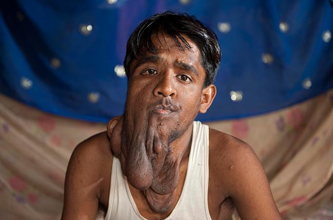 Lalit Ram, omul-elefant