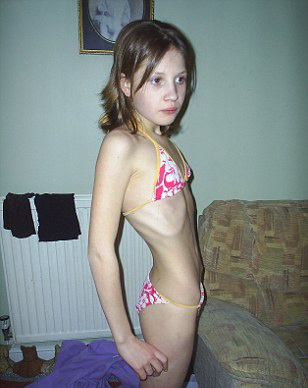 anorexica, Jo Thompson