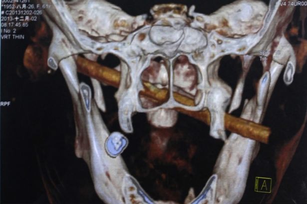 radiografie, bat in gura