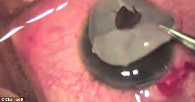 Tanara a decis sa-si schimbare culoare ochilor cu ajutorul unor discuri care se implanteaza in cornee