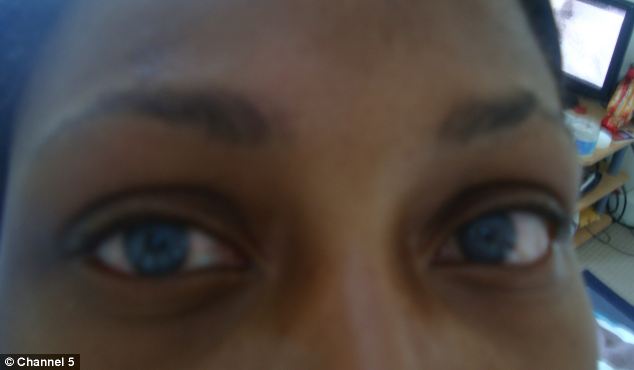 Culoarea albastra a ochilor este obtinuta in urma implantului cu discuri colorate