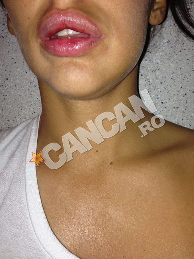 Weekenul trecut, Bianca a fost agresată în club de fostul iubit. Bruneta susţine că acesta a muşcat-o de buză şi de faţă şi că a tras-o de păr