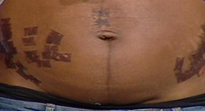 laurette abdomen ars