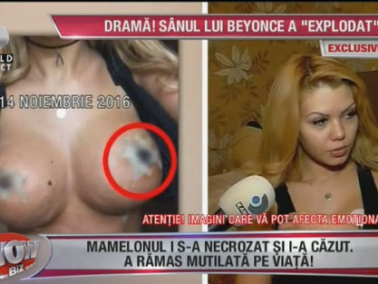 Aşa arată sânul vedetei după operaţia nereuşită