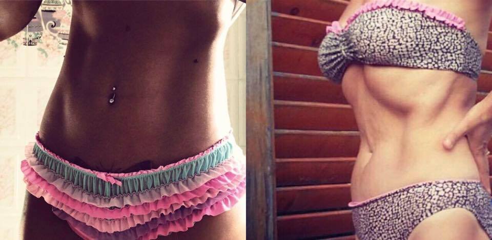 Abdomenul Roxanei Vancea (partea stângă) vs. abdomenul mamei ei (partea dreaptă)