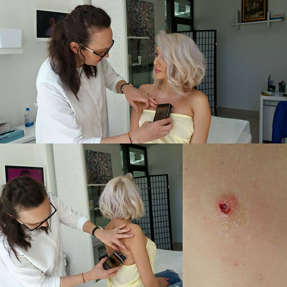 Medicul i-a extirpat Ralucăi o aluniţă