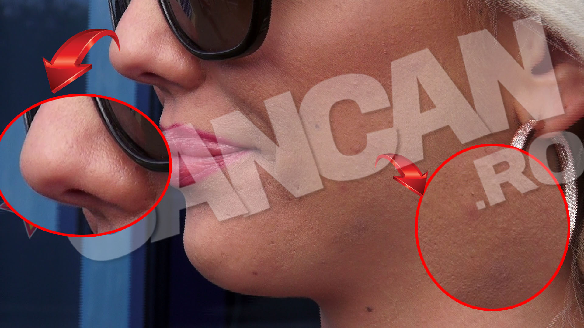 Alexandra Harra are probleme cu cosurile si porii dilatati